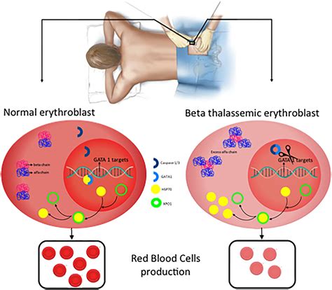 heterozygous beta thalassemia|Pathophysiology and Clinical Manifestations of the β.
